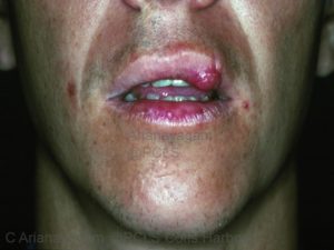 treatment lip injury