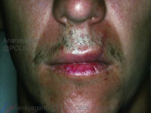 treatment lip injury