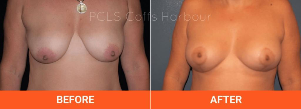 Breast Lift and Augmentation with Implants