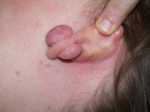 Keloid on earlobe