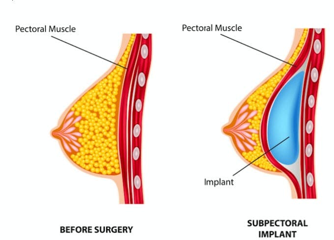 subpectoral placement of breast implants